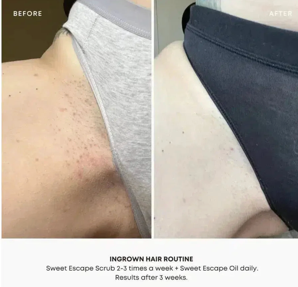 Bushbalm Sweet Escape Exfoliating Scrub Ingrown Hair (8oz/236ml)